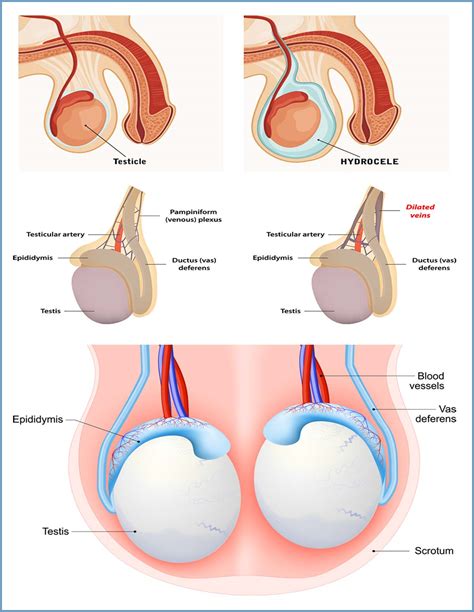 Hydrocele Vs Varicocele