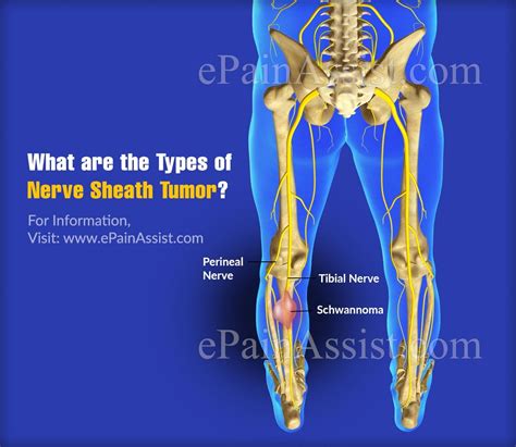 What Are The Types Of Nerve Sheath Tumor?