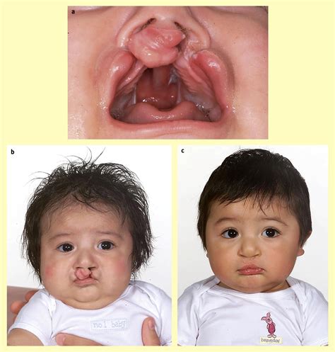 Cleft lip and palate: current management - Paediatrics and Child Health