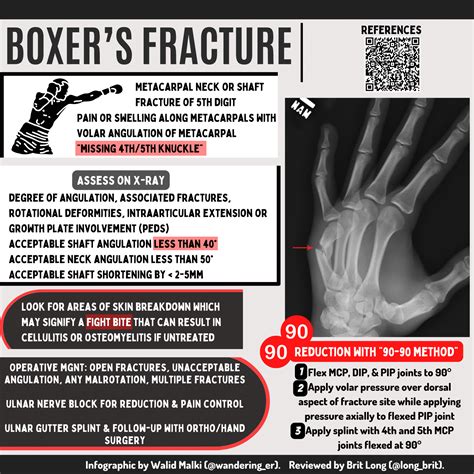 Visual Wednesdays: Boxer's Fracture - emDocs