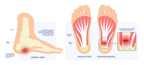Fasciitis Foot Symptoms