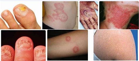 Fungal Infections | Health Vision - Health - Read this story on Magzter.com