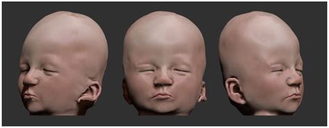 16p11.2 Microduplication Syndrome with Increased Fluid in the Cisterna ...