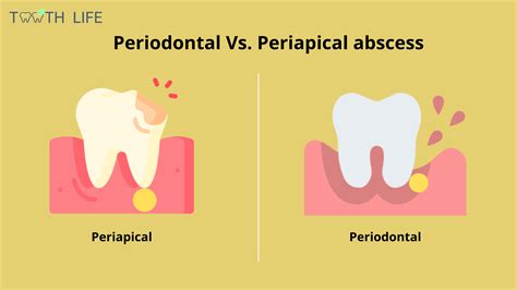 A Gum Abscess With no Pain Can be Worse than you Think. Here’s Why
