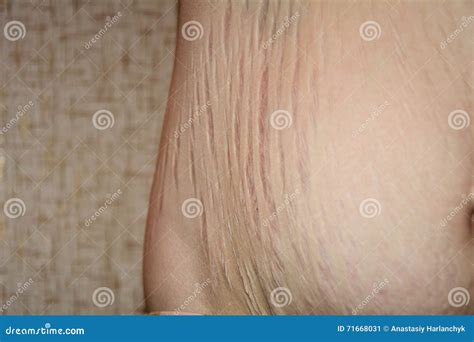 Stretch Marks after Pregnancy Stock Image - Image of medicine, dermis ...