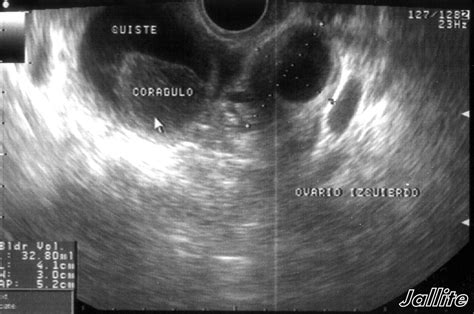 Quiste Ovario Hemorragico