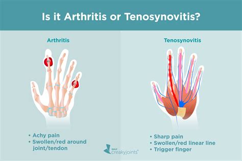 Wrist Pain Arthritis Or Tendonitis at Louise Mcmakin blog
