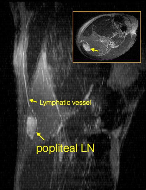 Popliteal Lymph Nodes Mri