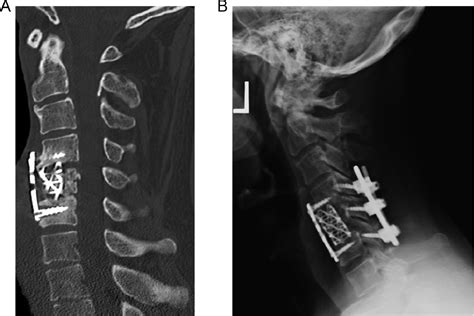 Comparison of revision surgery for pseudarthrosis with or without ...