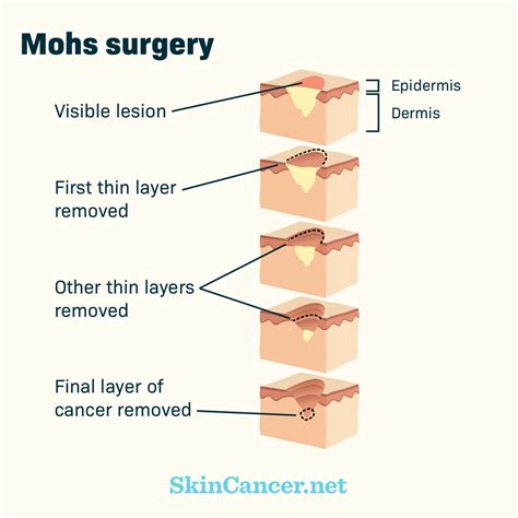 Mohs Surgery as a Skin Cancer Treatment Option | SkinCancer.net