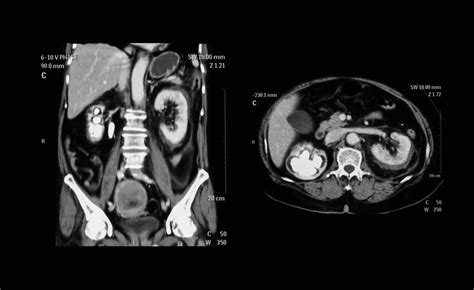 Kidney Stones - Fairbanks Urology