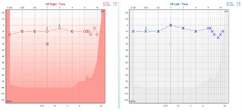 Diagnosis of Isolated Saccular Dysfunction Using Trapezius cVEMP: A ...