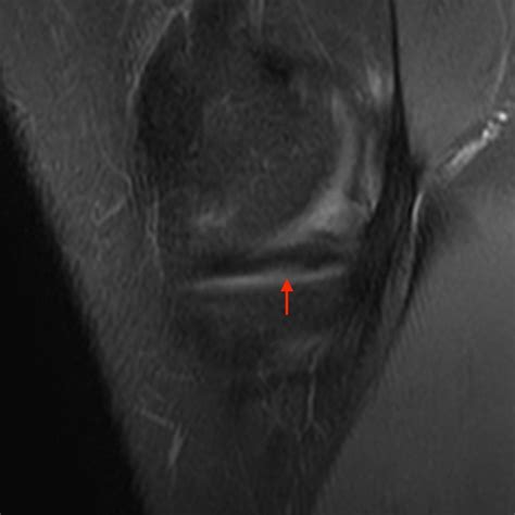 Bucket-handle Tear of the Meniscus - Radsource