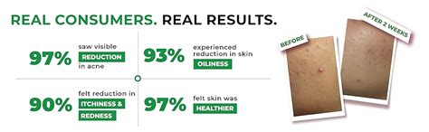 The Pink Foundry Acne Face Wash with 1.5% Salicylic Acid, Zinc PCA ...
