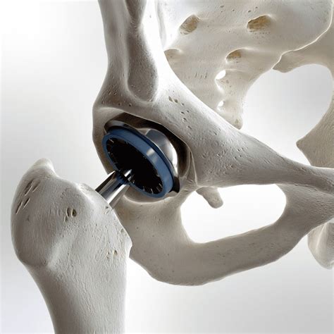 Hip Replacement Surgery - The More Clinics
