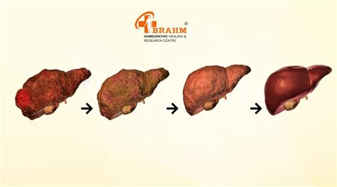 Liver Cirrhosis | Liver cirrhosis treatment | liver cirrhosis treatment ...