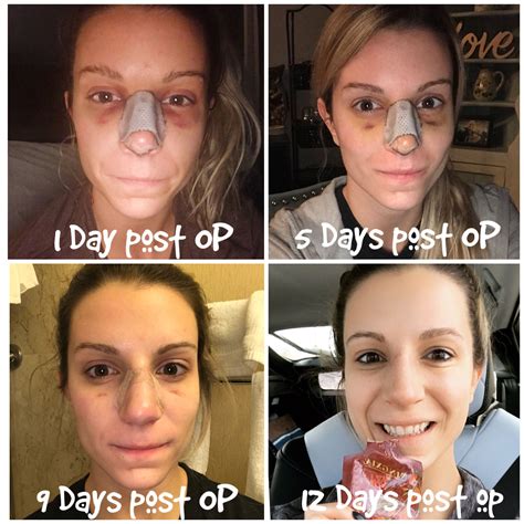 Nose Job Recovery Stages at Deborah Frias blog