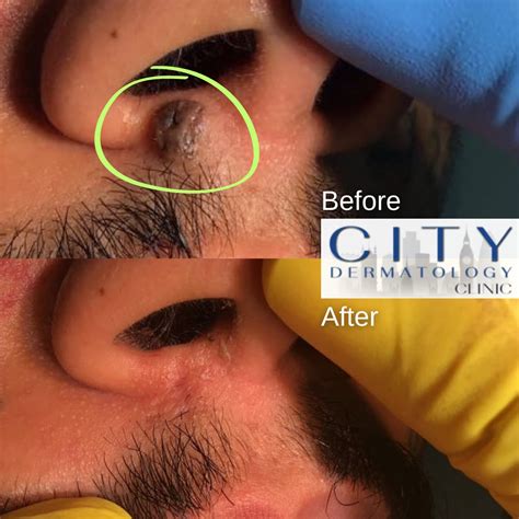 Before and After Photos Mole Removals
