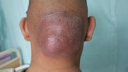 Free carbuncle Stock Photos - Stockvault.net