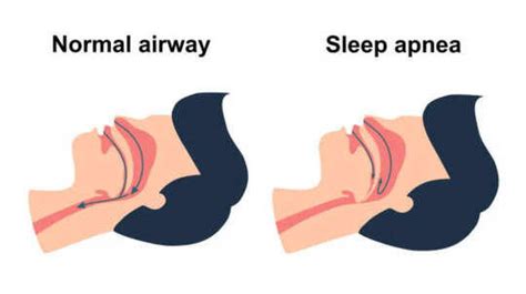 New sleep apnea pill cuts symptoms by 44% - could this replace CPAP ...