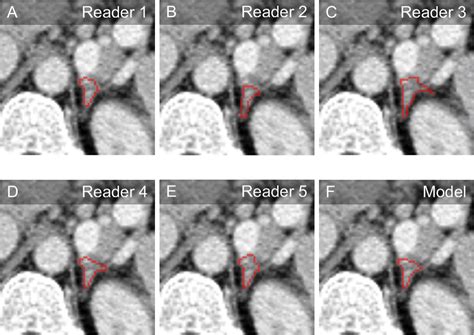 Machine Learning for Adrenal Gland Segmentation and Classification of Normal and Adrenal Masses ...
