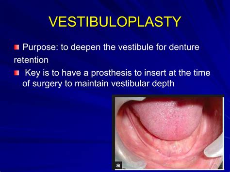 Preprosthetic surgery in prostho new.....ppt