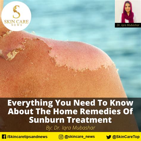 Everything you need to know about home remedies of Sunburn