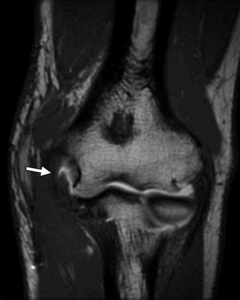 Ulnar Collateral Ligament Mri TFCC Tear And Ulnar Collateral Ligament
