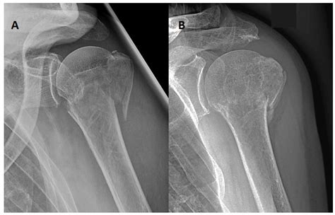 The Influence of Adherence to Orthosis and Physiotherapy Protocol on ...