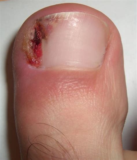 Ingrown Toenail Home Treatments - RemedyGrove