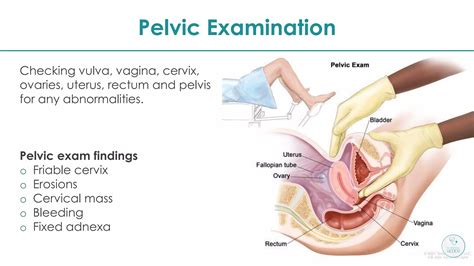 CERVICAL CANCER | PDF