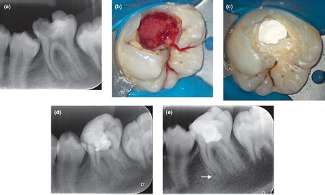 Vital pulp therapy for permanent teeth with diagnosis of irreversible pulpitis: biological basis ...