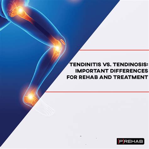 Tendinitis, Tendinosis, Tendinopatía ¿Cuál Es La Diferencia? – GZVZU