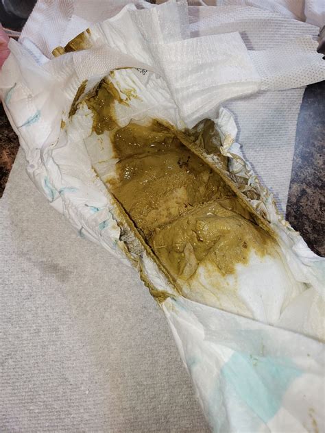 Nutramigen poops- gross photo | BabyCenter