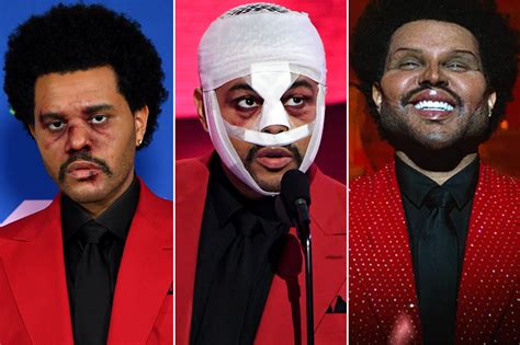 The Weeknd's Billboards face: Bloody 'surgery' shocker?