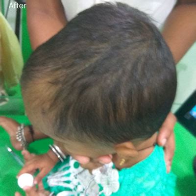 Case 4 | Dr. Aditi's Homeopathy Hair Clinic