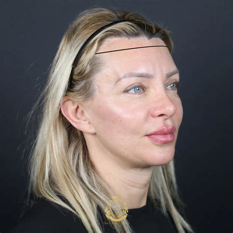 Women Receding Hairline