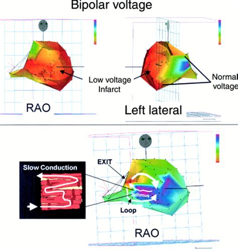 Cardiac Ablation Entry Point at Ernie Gill blog