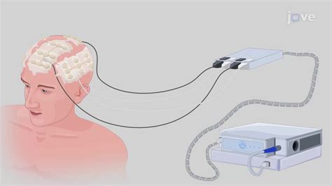 Video: Tumor Treating Fields Application in Human Brain Tumor Models: A ...