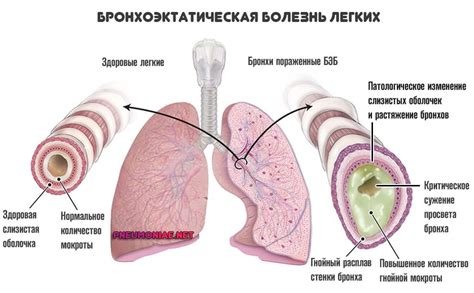 Кашель курильщика: симптомы и лечение медикаментами