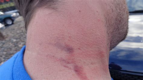 Photos show bruised neck of motorist suing Reno police for excessive force