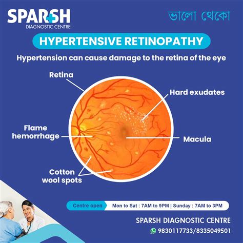 Hypertensive Retinopathy - Sparsh Diagnostic Center