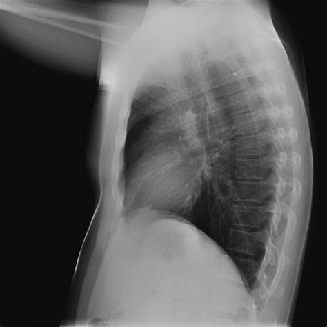 Las 2 proyecciones básicas en radiología torácica estándar | Live-Med