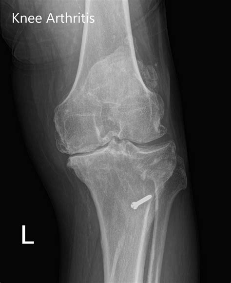 List 105+ Pictures Knee Anatomy X-ray Excellent