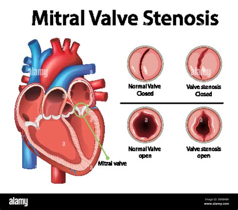 Detailed vector illustration of mitral valve stenosis, highlighting ...
