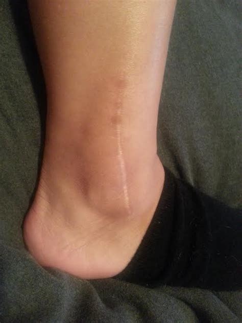 My Broken Ankle =(: 4 years 5 months - Surgery Scar