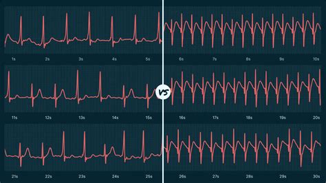 Wolff-Parkinson-White Syndrome Vs. Supraventricular Tachycardia (Sustained) on Your Watch ECG | QALY