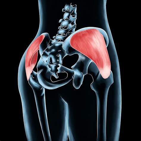 Gluteus Medius Pain