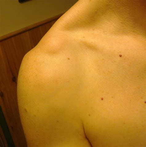 Painful Lump On Shoulder Blade / Breast lump and shoulder blade pain.