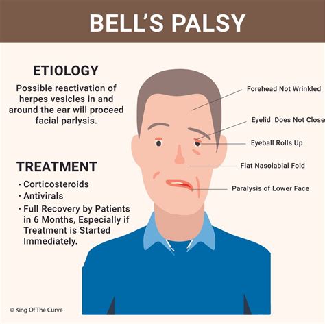 Bell’s Palsy: Symptoms, Causes, and Treatment Guidelines — King of the Curve